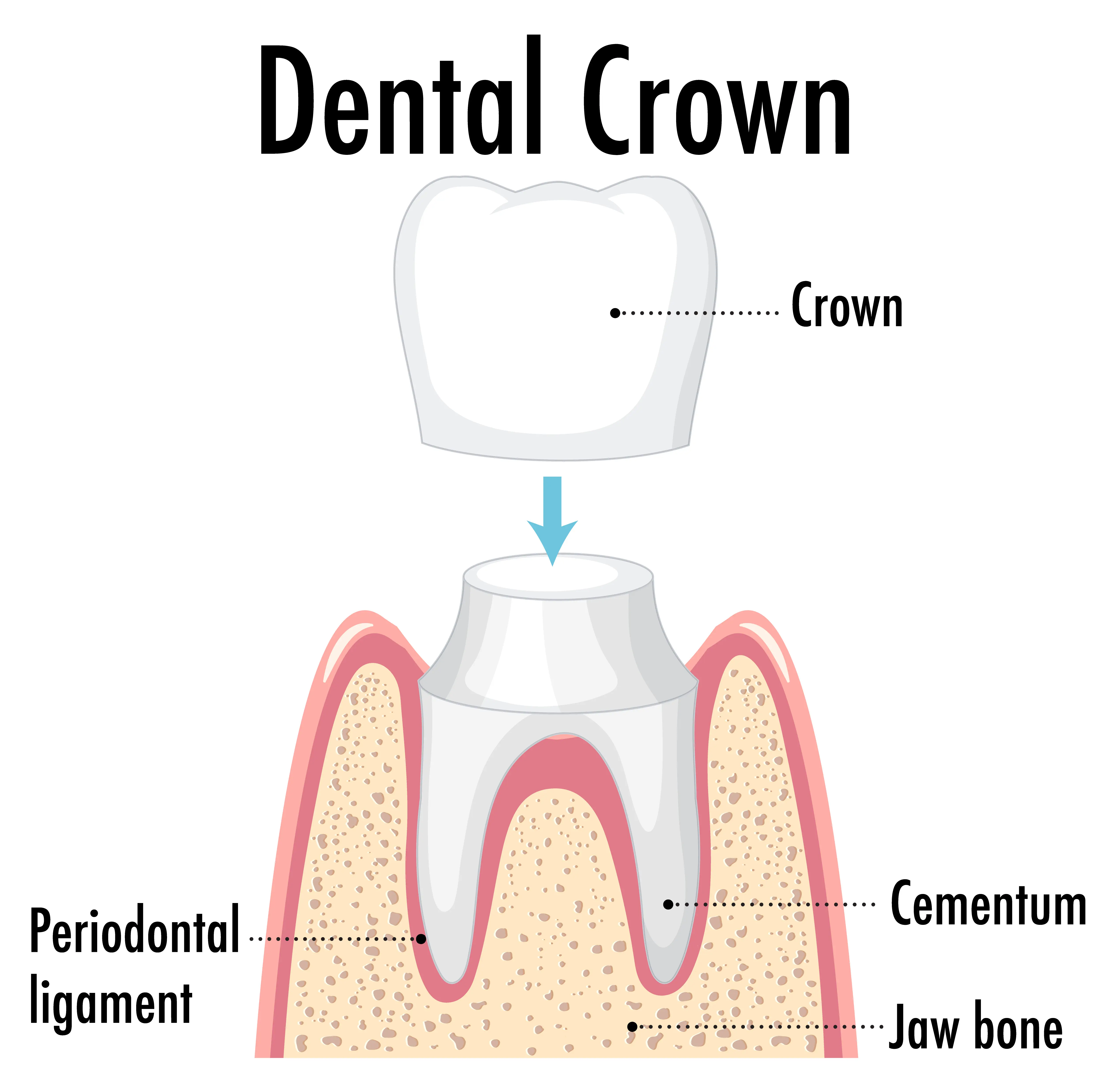 Dental Crowns